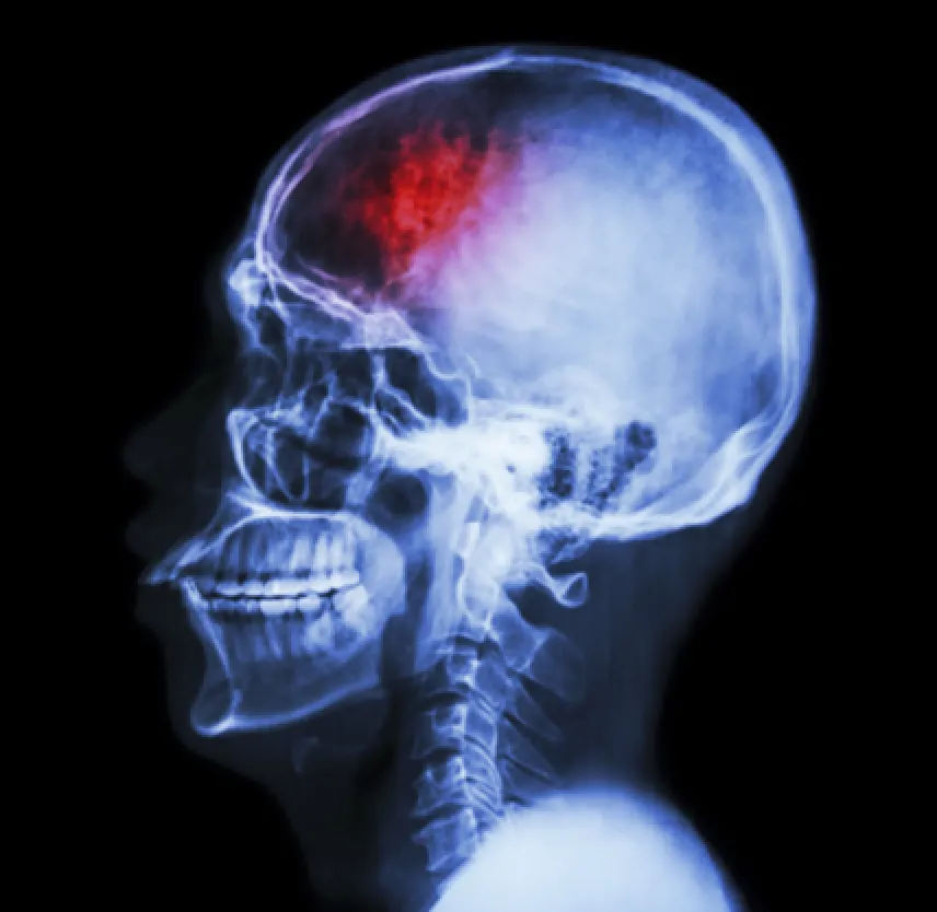 Brain Injuries - The McAllen Personal Injury Lawyer